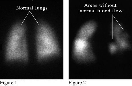 Lung Nuclear Medicine Scan | University Of Michigan Health System