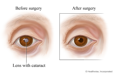 why is my vision wavy after cataract surgery