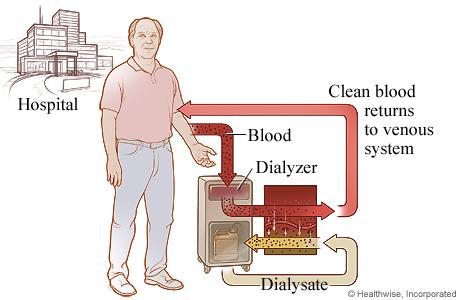 hemodialysis dialysis process nurseslabs nursing care dialyzer