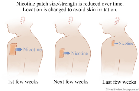 Nicotine Patch Makes Arm Sore