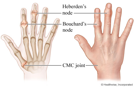 Heberden's And Bouchard's Nodes | University Of Michigan Health System