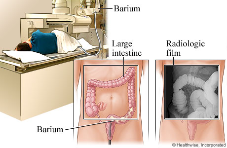 Barium Contrast