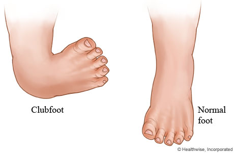 Clubfoot | University Of Michigan Health System