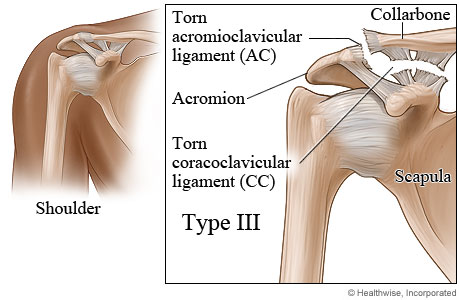 type acromion