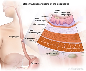 Esophageal Cancer Treatment Adult Pdq Treatment Patient