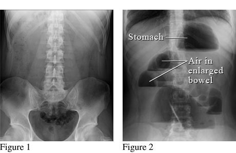 Abdominal X-Ray of a Bowel Obstruction | University of Michigan Health ...