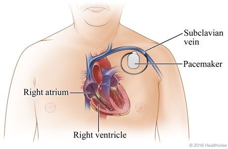 Permanent Pacemaker | University of Michigan Health System