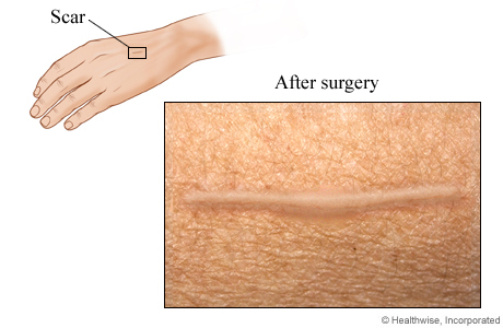 Melanoma Excision and Scar | University of Michigan Health System