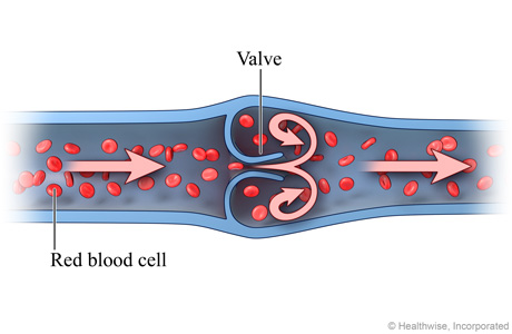 Blood Clot in a Vein | University of Michigan Health System