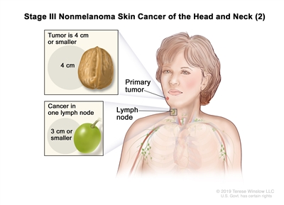 Skin Cancer Treatment (PDQ®): Treatment - Patient Information [NCI ...