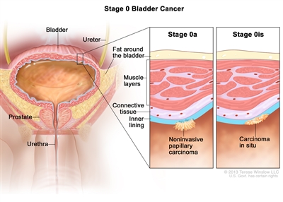 Bladder Cancer Treatment Pdq Treatment Health Professional Information Nci Michigan Medicine