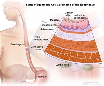 Esophageal Cancer Treatment Adult Pdq Treatment Patient Information Nci Michigan