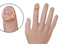 Warts And Plantar Warts Michigan Medicine