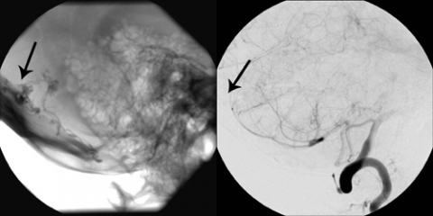 Lateral Cerebral Angiogram