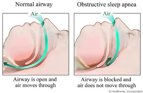 Central sleep apnea: Diagnosis and treatment