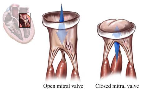 Mitral Valve Disease University of Michigan Health