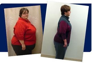 Before and after photos of bariatric female patient