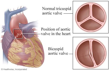 Bicuspid Aortic Valve BAV University of Michigan Health