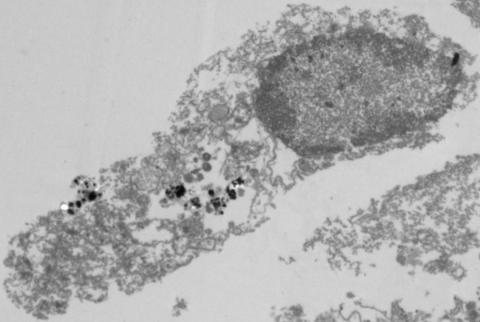 La distruzione della cellula tumorale a causa di un trattamento con nanoparticelle e la luce visibile.