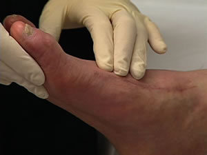 Foot problems common among people with diabetes | Michigan ...